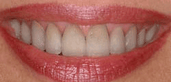 Teeth Whitening